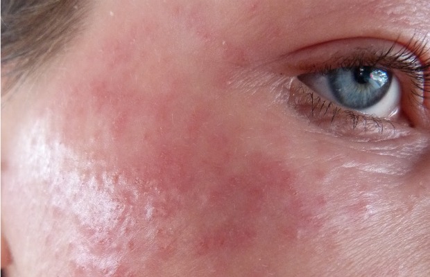 ECZEMA CARA 620+400