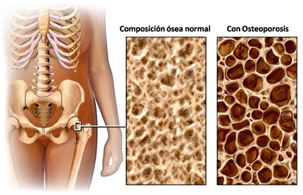 osteoporosis_porosidad_hueso 620+400